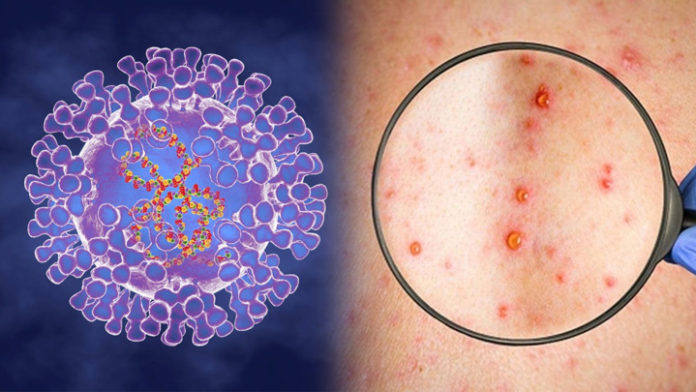 оспа обезьян